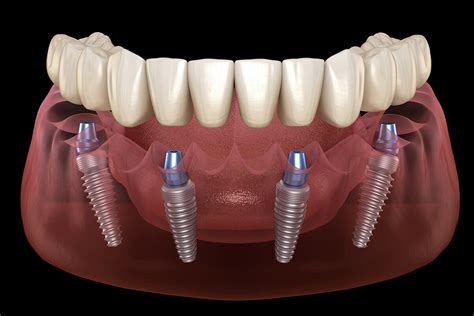 affordable all on four implants